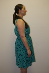Weight Loss 2 - Before Treatment